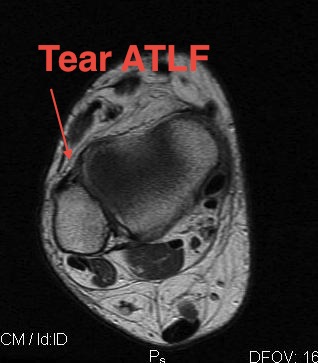 MRI Torn ATFL Axial Vew